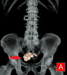 膀胱結石の３D　CT画像