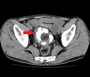 膀胱結石のCT画像