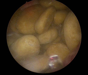 膀胱結石の内視鏡画像